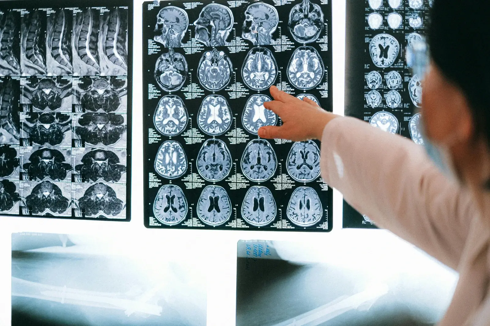 Une dame pointant du doigt une radio du cerveau